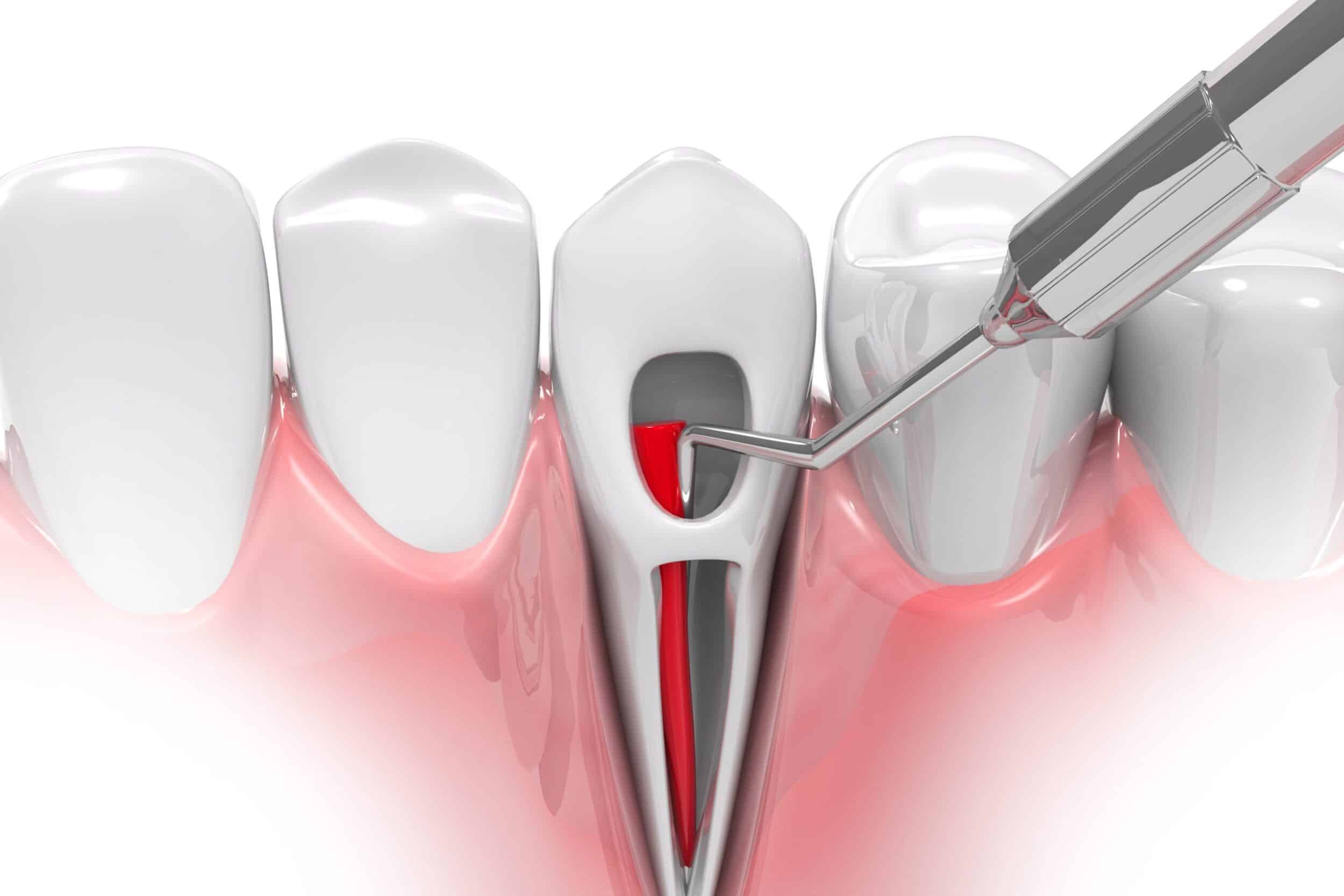 1742824577 Root Canal Therapy scaled