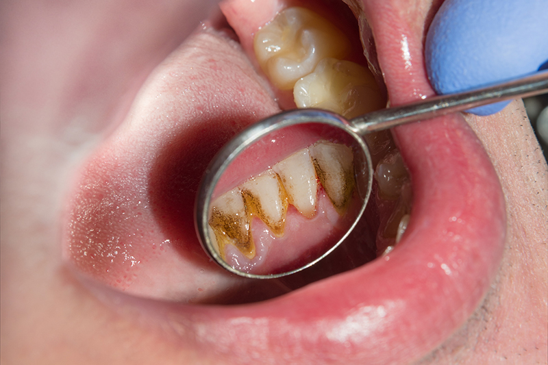 Close up of macro dental calculus and dental plaque. Oral hygiene in dentistry